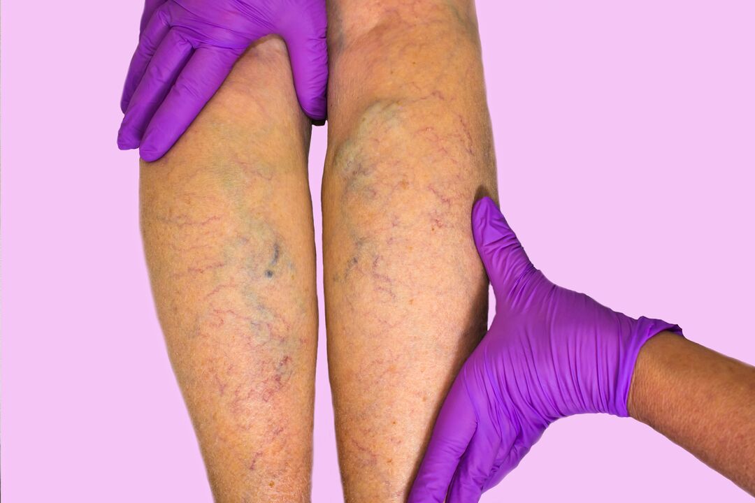 Varices sur les jambes