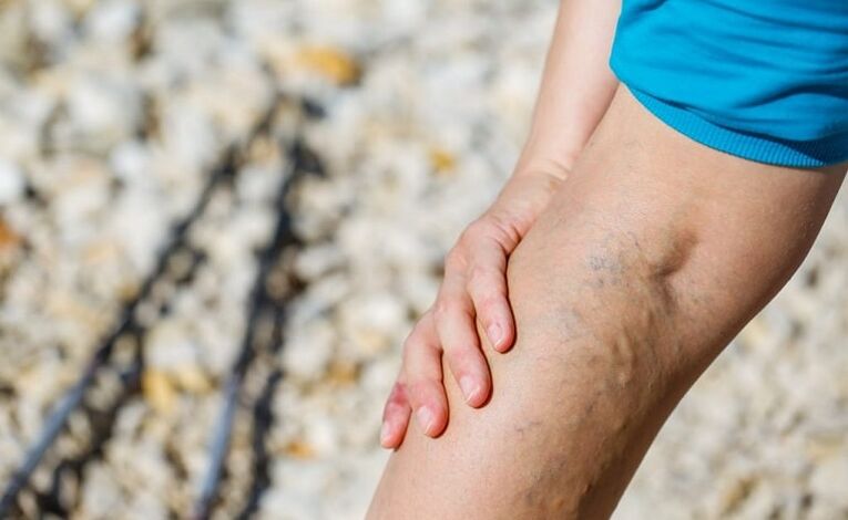 Varices sur la jambe